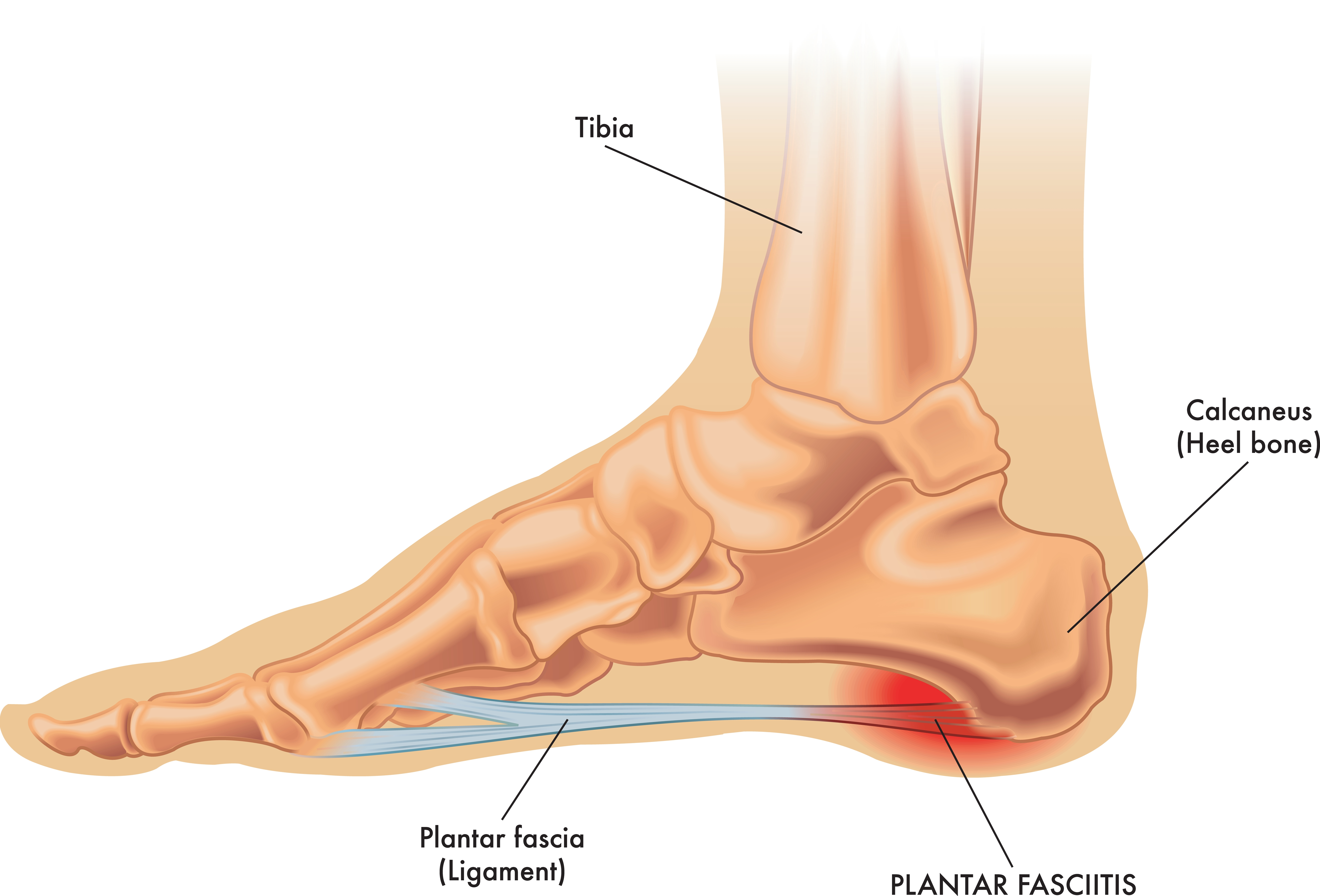 orthopedic plantar fasciitis