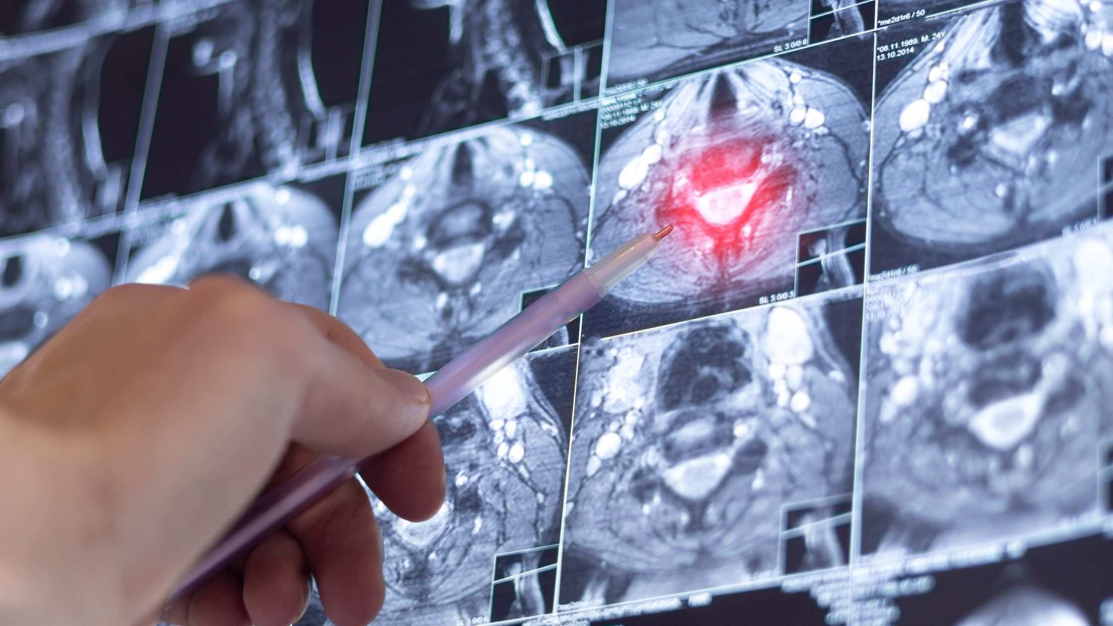 The New Era of MS Care: Treatments and Tools Transforming the Future